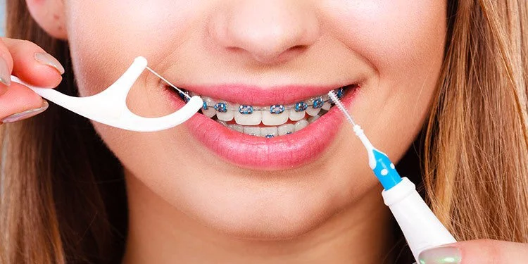 7 Tips Menjaga Gigi Sehat Saat Menggunakan Behel